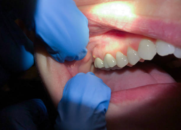Best Dental Abscess Treatment in South Coventry, CT